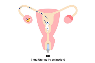 How does IUI work?