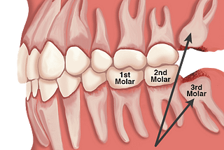 The Need Of Tooth Extraction