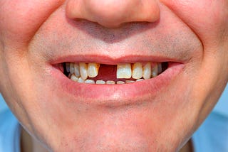 What is the best dental procedure for missing teeth?