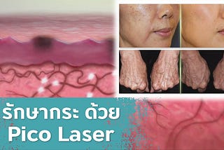 Pico Second Laser เลเซอร์แก้ปัญหากระ อย่างได้ผล