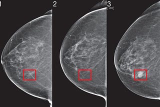 Revolutionary AI System From MIT Predicts Breast Cancer Five Years in Advance