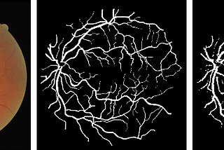 Retina Blood Vessel Segmentation using VGG16-UNET