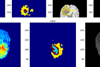 Brain tumor multi class unet segmentation