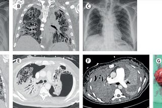 Lung transplantation in corona patients