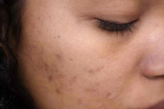 The Secret to Treating Acne Scars Revealed