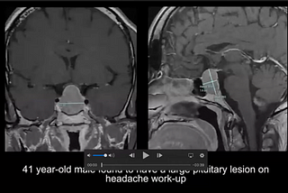 Observing a Real Brain Tumour Resection — While in Highschool