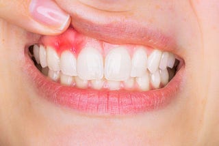 Foods that Cause Gum Disease