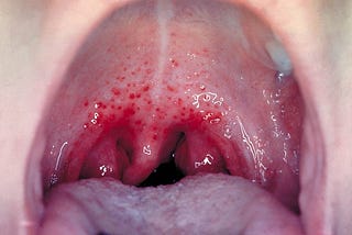 Understanding Strep Throat: Symptoms, Treatment, and Prevention