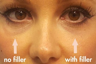 All those things you need to know about the Under-eye filler