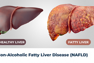 Fatty Liver Disease — An Insight