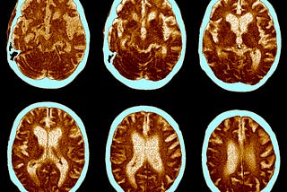 Why Drugs for Alzheimer’s Are So Hard to Develop
