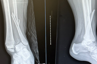An X-ray showing a broken fibula and a dislocated ankle.