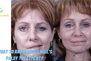 What to Know About Bell’s Palsy Treatment?