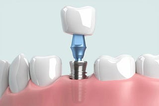 Teeth, Implants, and Potential Issues of Profit Against Health and Ethics