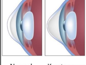 Detecting Keratoconus from Corneal Imaging using Deep Learning