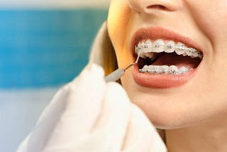 The Benefits of Choosing Braces in Lake Forest