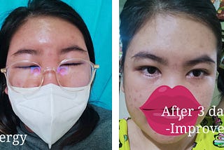Navigating Acne and Unexpected Allergies: A Journey to Confidence and Caution