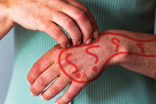 Unraveling the Mystery of Phantom Itch: Causes, Symptoms, and Treatment