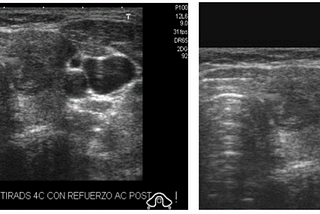 The Basic Classification of Thyroid Tumors on UltraSound Images using Deep Learning Methods