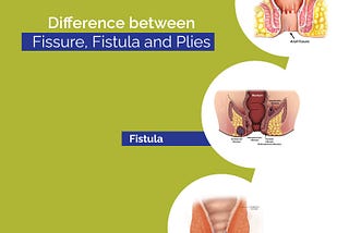 Difference between fissures fistula and plies