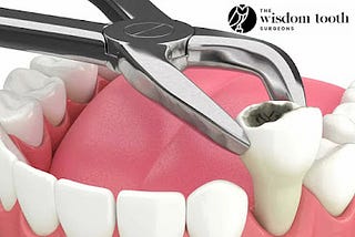 How to Get Ready for Wisdom Tooth Extraction?