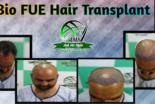 FUE Hair Transplant