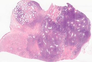 Primary Large B-Cell Lymphoma in the Testis