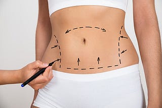 liposuction Bedminster