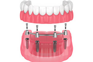 Guide To Maintain Implant-Supported Dentures