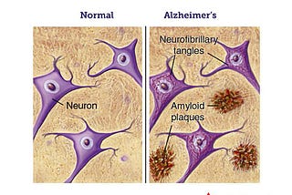 Watch out! Poor Sleep at Night may Bring you Closer to Alzheimer’s