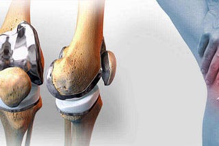 Information About the Total knee Replacement Surgery