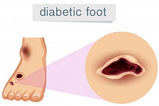 Diabetic foot care