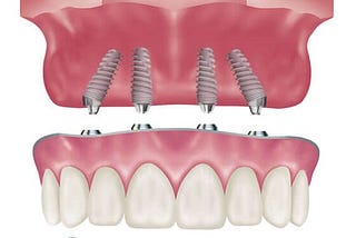 Frequently Asked Questions About Dental Implants & Periodontics