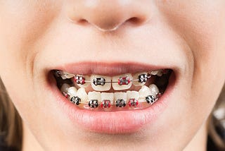 Common Orthodontic Conditions Observed in Children