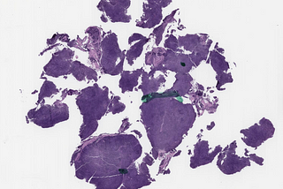 NLPHL, Variant Pattern, EBV+ with CHL-Like Morphology