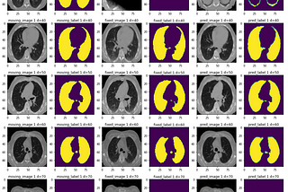 Monai Starts to Explore Learning-Based Medical Image Registration