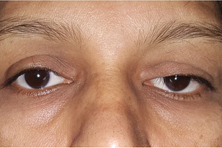 Understanding Ptosis: Causes, Symptoms, Diagnosis, and Treatment