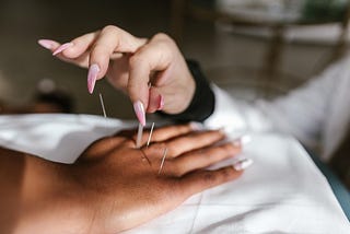 woman acupuncture hand