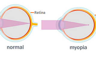 A Sensational Eye-Opener Write-Up To Reverse Myopia In Kids (Sept 2021)