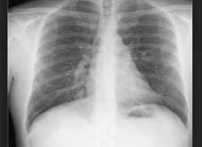 Classifying COVID-19 X-ray images