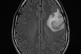 A quick guide to having oligodendroglioma