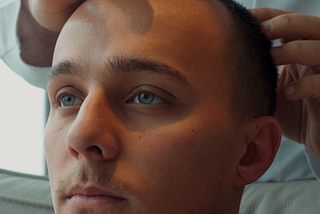 A doctor carefully examines a patient’s scalp with both hands during a pre-procedure assessment, the patient looking forward with a calm and thoughtful expression.
