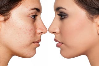 Will Probiotics in Your Skin Care Products Help Improve Your Acne?