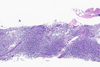 Primary Nodal EBV-Positive NK/T-Cell Lymphoma