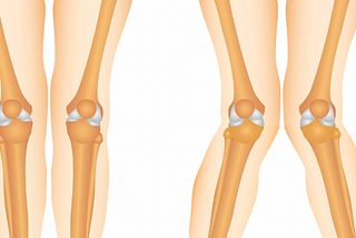 This 3-Minute Exercise Program Will Solve Your Knocked Knees