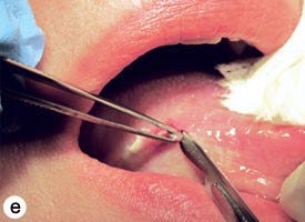 Oral Biopsy