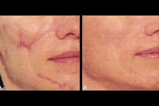 The Most Important 10 tips to know before having laser treatment for Scars removal treatment in…