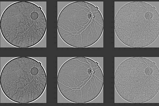 Transfer Learning with Diabetic Retinopathy Diagnosis