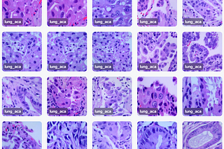 Metastatic Adenocarcinoma Classification With Lobe