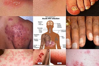 (HIV)
The human immunodeficiency virus (HIV) is a lentivirus (a subgroup of retrovirus) that causes…